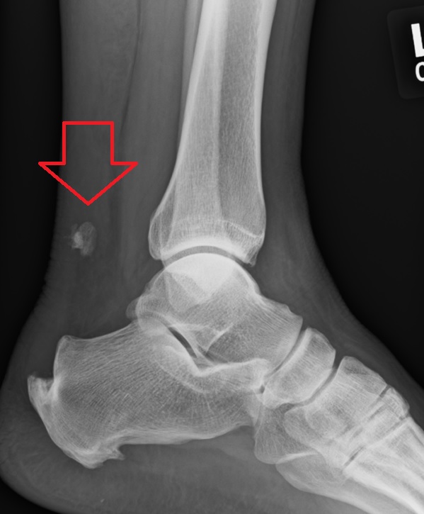 Achilles tendon rupture