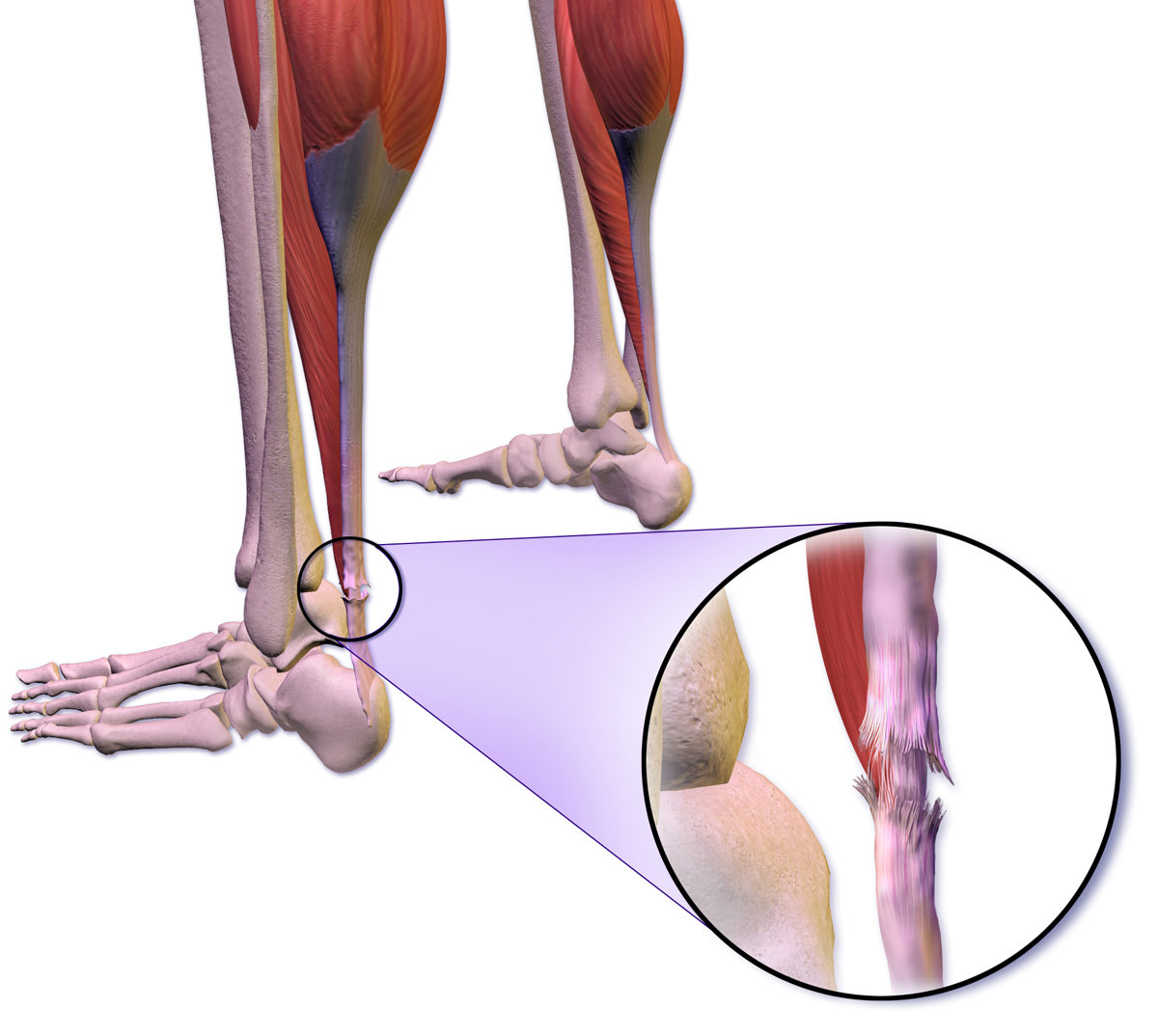 Achilles tendon rupture