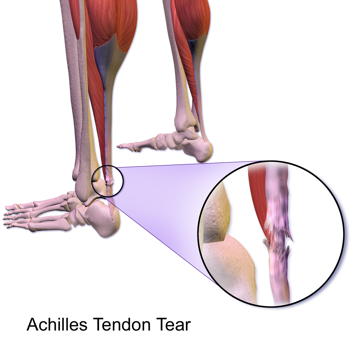 Achilles tendon rupture