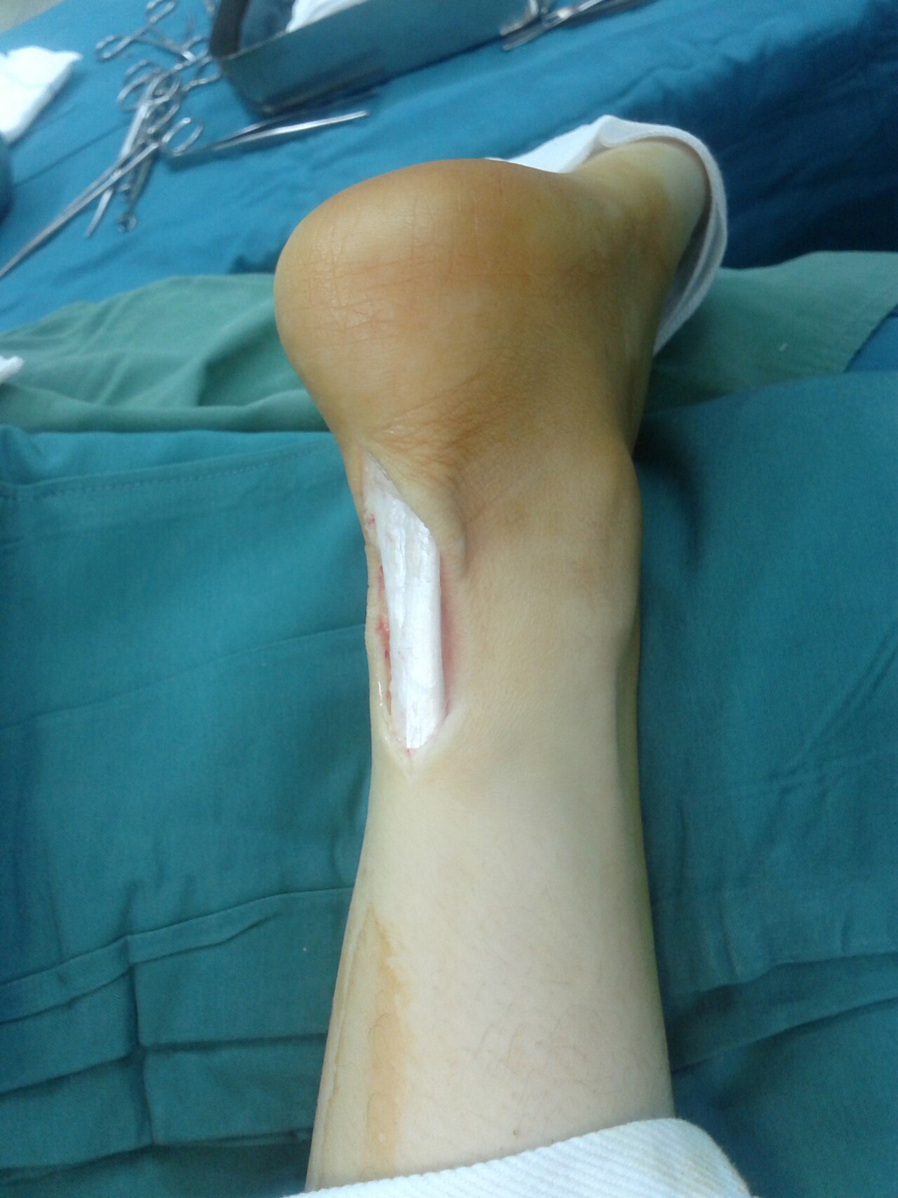Achilles tendon rupture