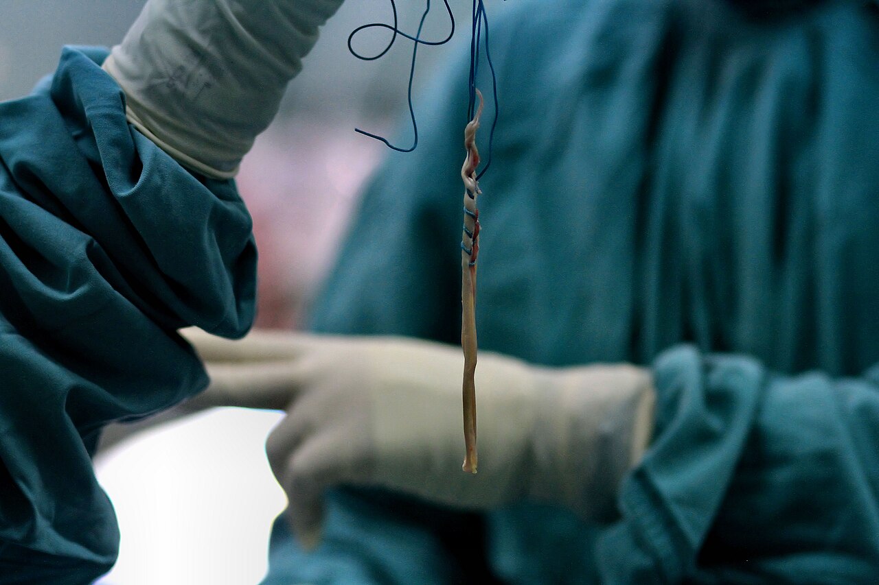 Anterior cruciate ligament injury