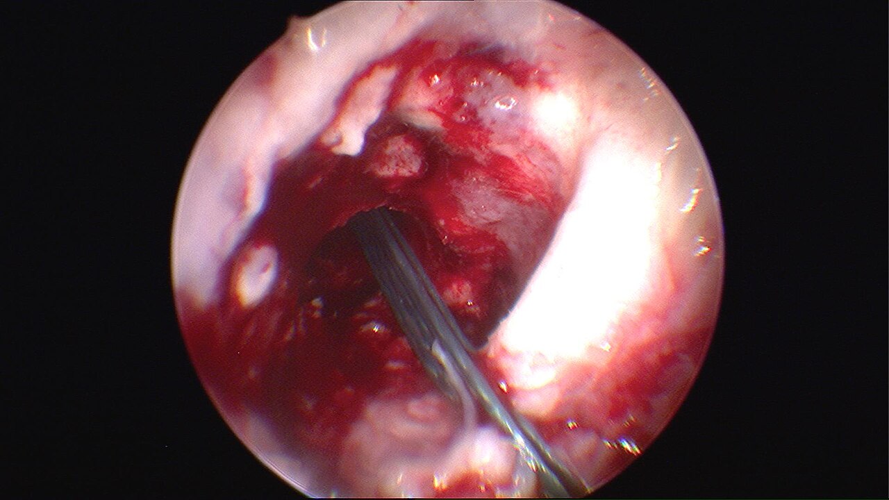 Anterior cruciate ligament injury