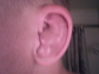 Cauliflower ear