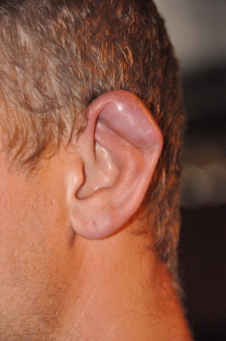 Cauliflower ear