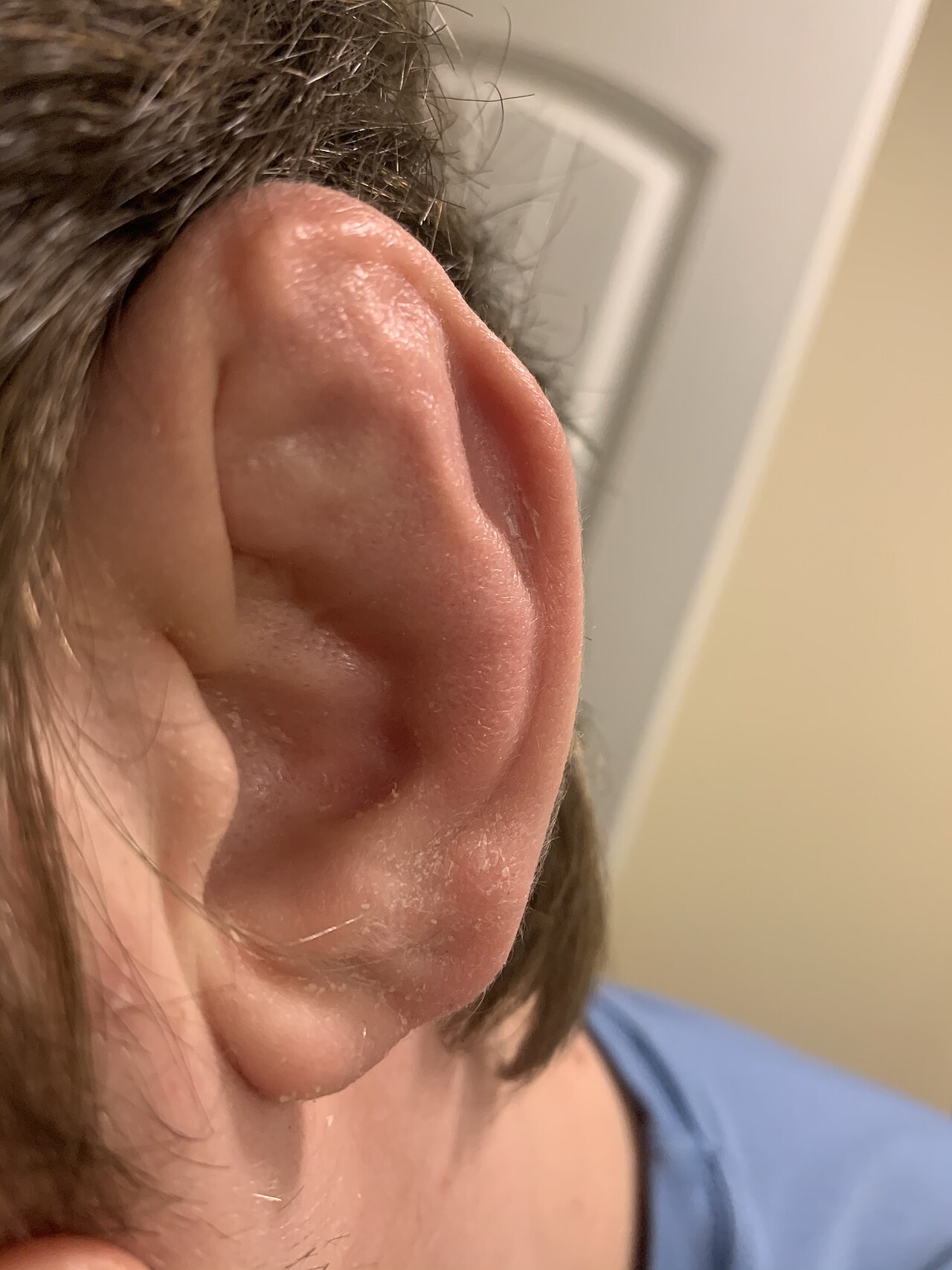 Cauliflower ear